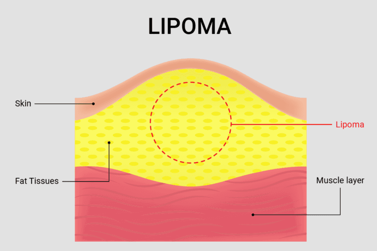 Cross section diagram of lipoma